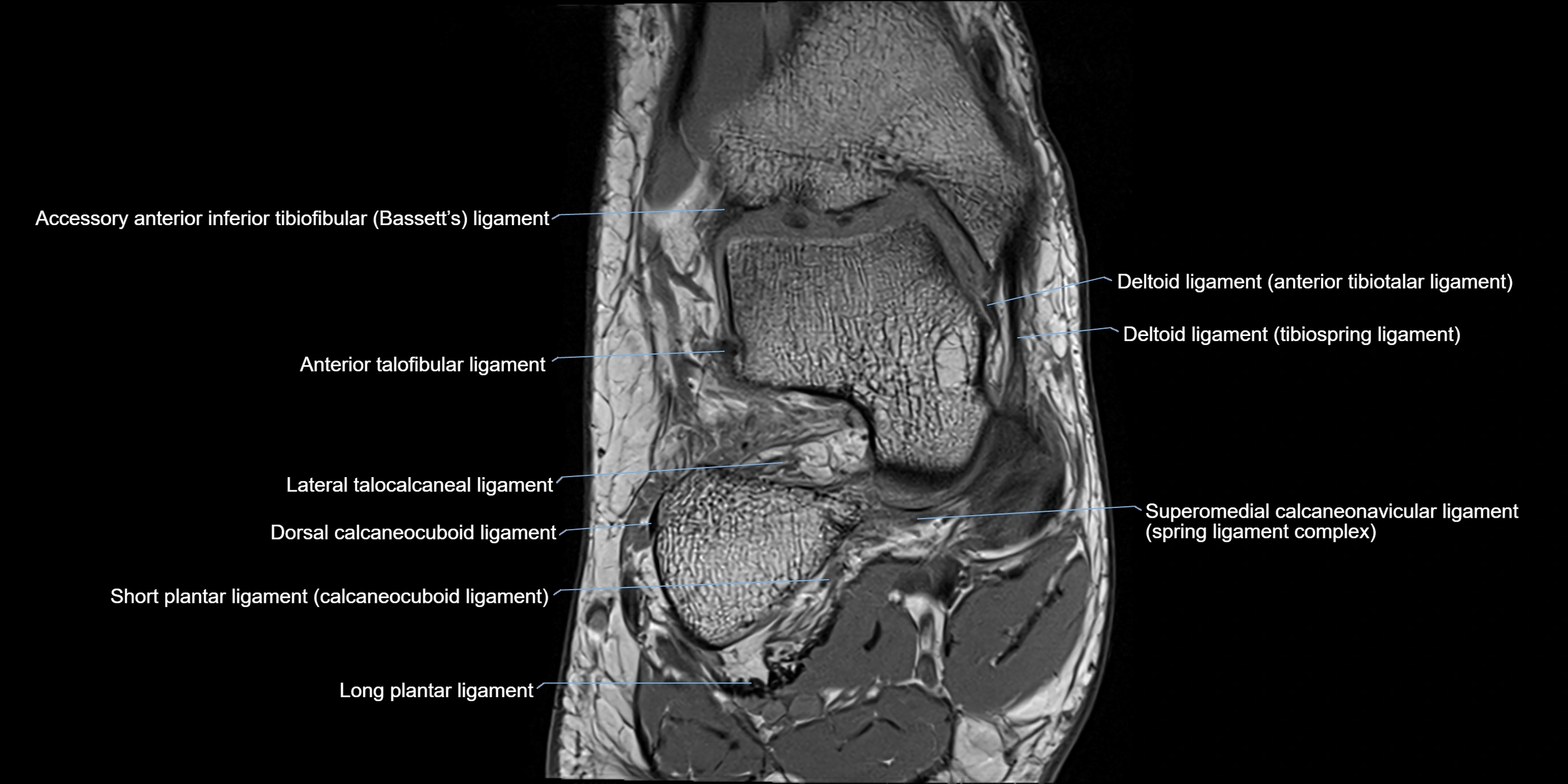 MRI Ankle coronal ligaments cross sectional anatomy 3T  radiology  image-img-00001-00007.webp